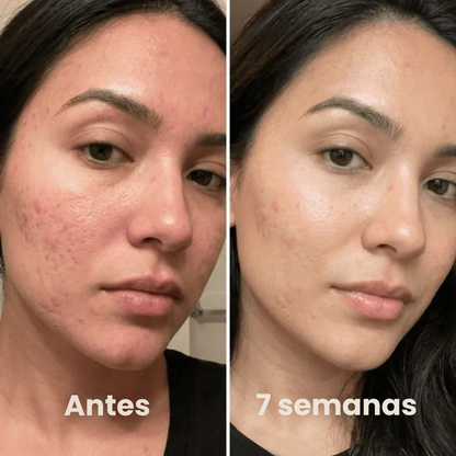 Stick Clínico Antiacné – Acción Localizada