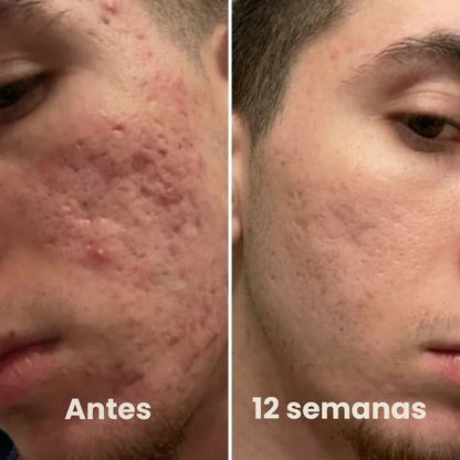 Stick Clínico Antiacné – Acción Localizada